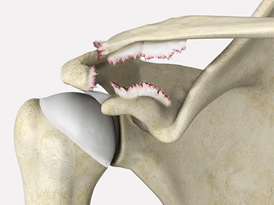 AC Joint Separation - Educational Picture