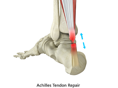 Achilles Tendon Repair - Educational Picture
