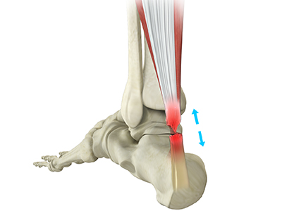 Achilles Tendon Rupture - Educational Picture