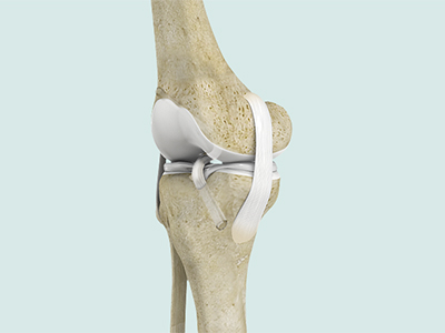 ACL Reconstruction - Educational Picture