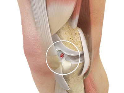 ACL Tears - Educational Picture