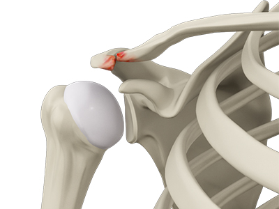 Acromioclavicular (AC) Arthritis - Educational Picture