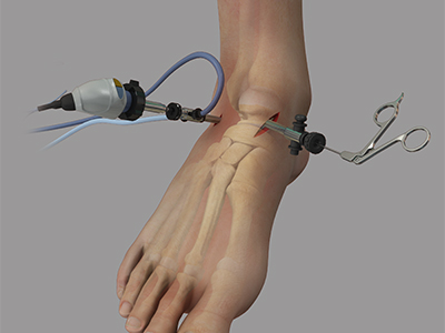 Ankle Arthroscopy - Educational Picture