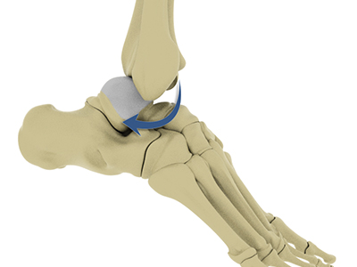 Ankle Dislocation - Educational Picture