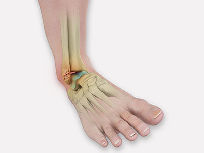 Ankle Fractures - Educational Picture