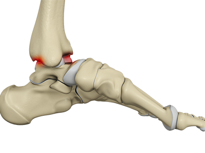 Ankle Impingement - Educational Picture