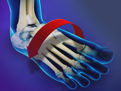 Ankle Instability - Educational Picture