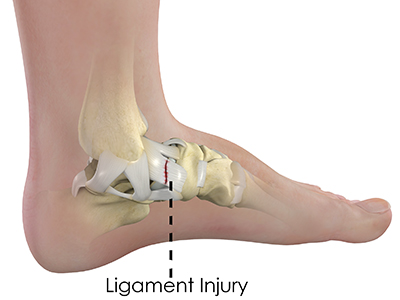 Ankle Ligament Injury - Educational Picture