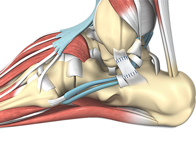 Ankle Ligament Reconstruction - Educational Picture