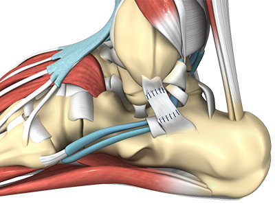 Ankle Sprain - Educational Picture