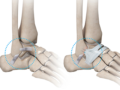 Ankle Stabilization - Educational Picture