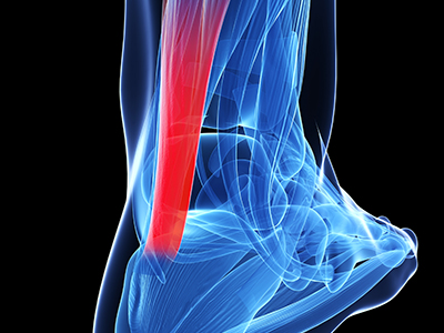Ankle Tendonitis - Educational Picture