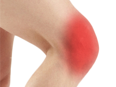 Anterior Knee Pain - Educational Picture
