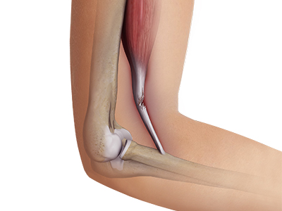 Bicep Tendon Tear at the Elbow - Educational Picture