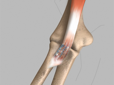 Biceps Tendon Repair - Educational Picture