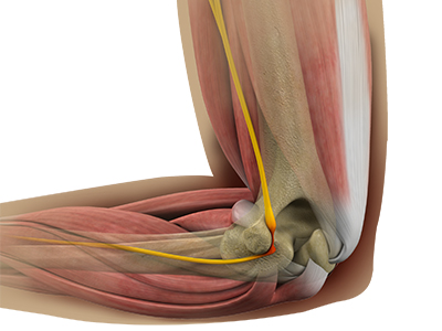 Cubital Tunnel Release (Medial Epicondylectomy) - Educational Picture