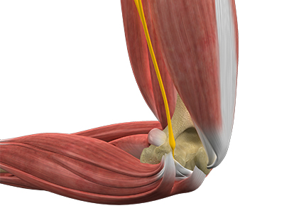 Cubital Tunnel Syndrome (Ulnar Nerve Entrapment) - Educational Picture
