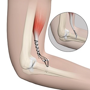 Distal Biceps Repair - Educational Picture