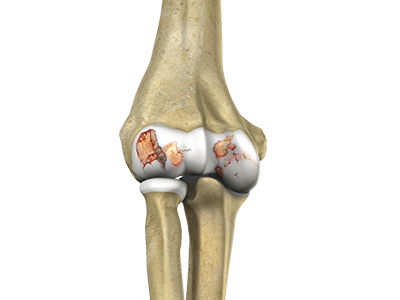 Elbow Arthritis - Educational Picture