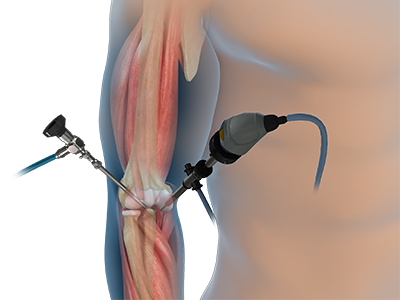 Elbow Arthroscopy - Educational Picture