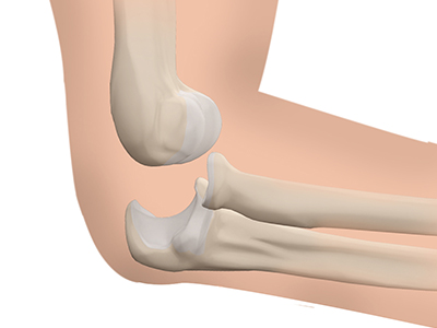 Elbow Dislocation - Educational Picture
