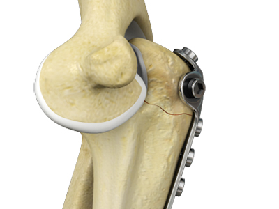 Elbow Fracture Reconstruction - Educational Picture