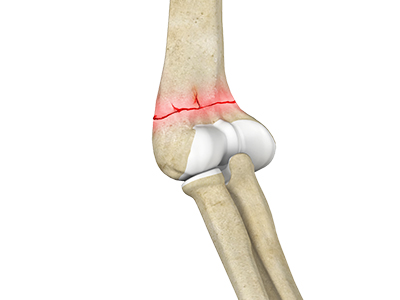 Elbow Fractures - Educational Picture
