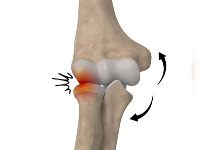 Elbow Impingement - Educational Picture