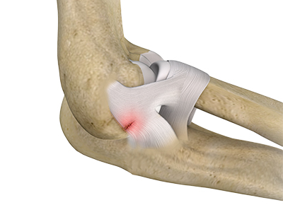 Elbow Ligament Injuries - Educational Picture