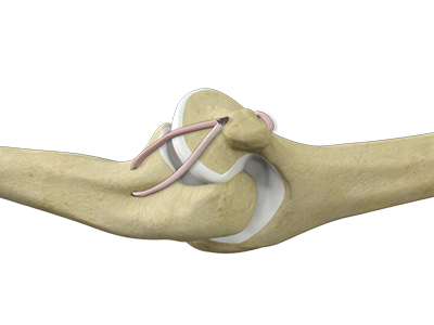 Elbow Ligament Reconstruction - Educational Picture