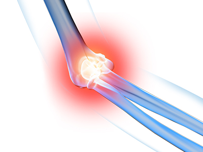 Elbow Pain - Educational Picture