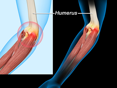 Elbow Sprain - Educational Picture
