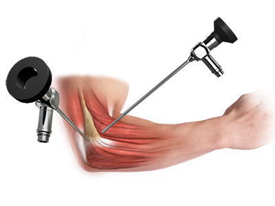 Elbow Surgery - Educational Picture