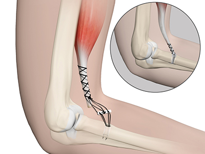 Elbow Tendon and Ligament Repair - Educational Picture