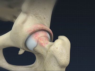 Femoroacetabular Osteoplasty - Educational Picture