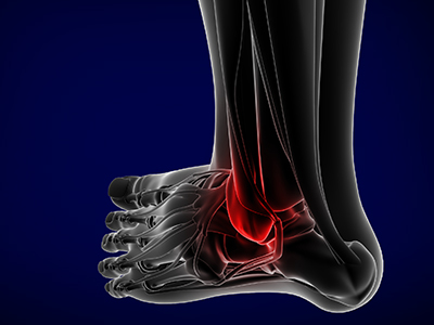 Foot and Ankle Trauma - Educational Picture
