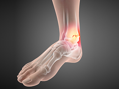 Foot Fracture - Educational Picture