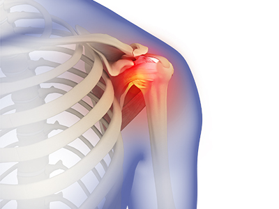 Frozen Shoulder - Educational Picture