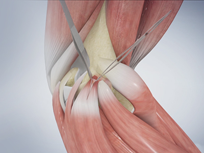 Golfer's Elbow Surgery - Educational Picture