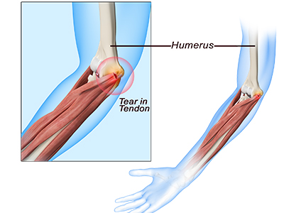 Golfer's Elbow - Educational Picture
