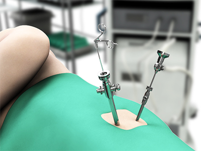 Hip Arthroscopy - Educational Picture