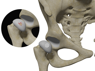 Hip Cartilage Restoration - Educational Picture