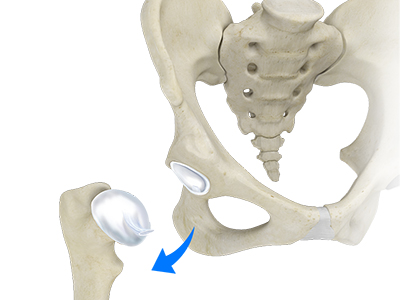 Hip Dislocation - Educational Picture