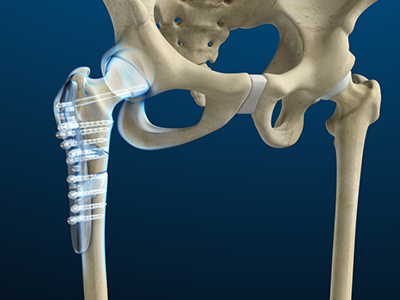Hip Fracture Surgery - Educational Picture