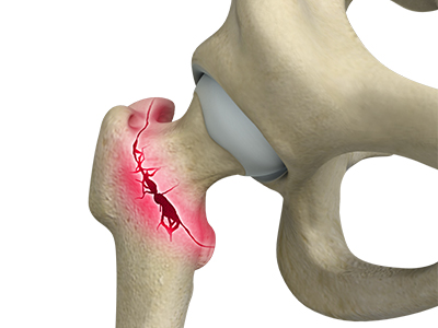 Hip Fracture - Educational Picture