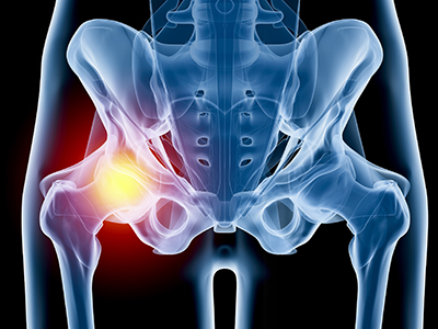 Hip Injury - Educational Picture