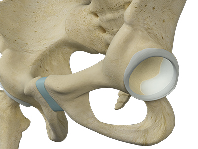 Hip Labral Augmentation - Educational Picture