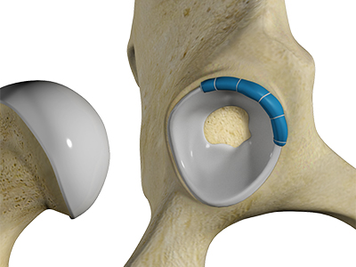Hip Labral Reconstruction - Educational Picture