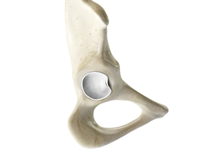 Hip Labral Tear - Educational Picture
