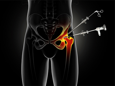 Hip Surgery - Educational Picture